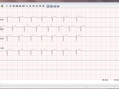 EKG-Auswertung1